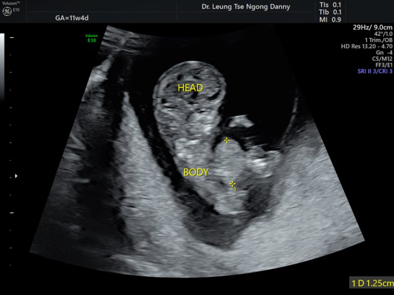 Omplaocele (also Called ‘Exomphalos’) - HKOG-INFO