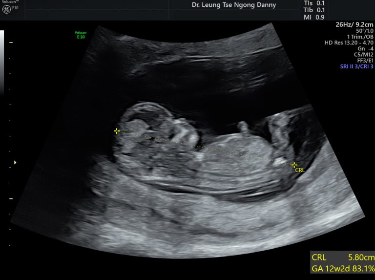 Nuchal translucency ultrasound - HKOG-INFO