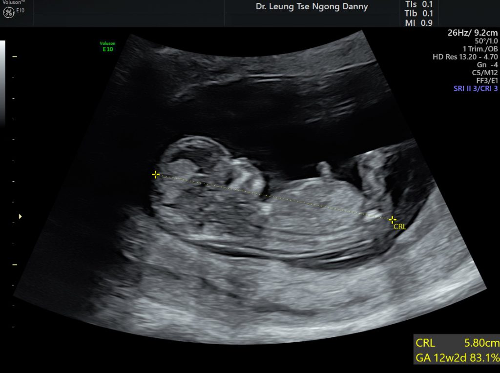 Fetal Biometry - HKOG-INFO