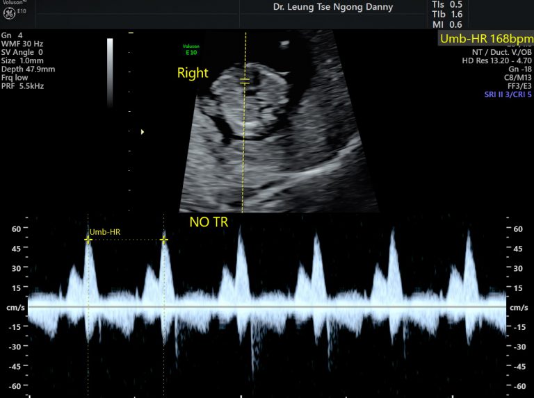 First Trimester Fetal Morphology Scan - HKOG-INFO