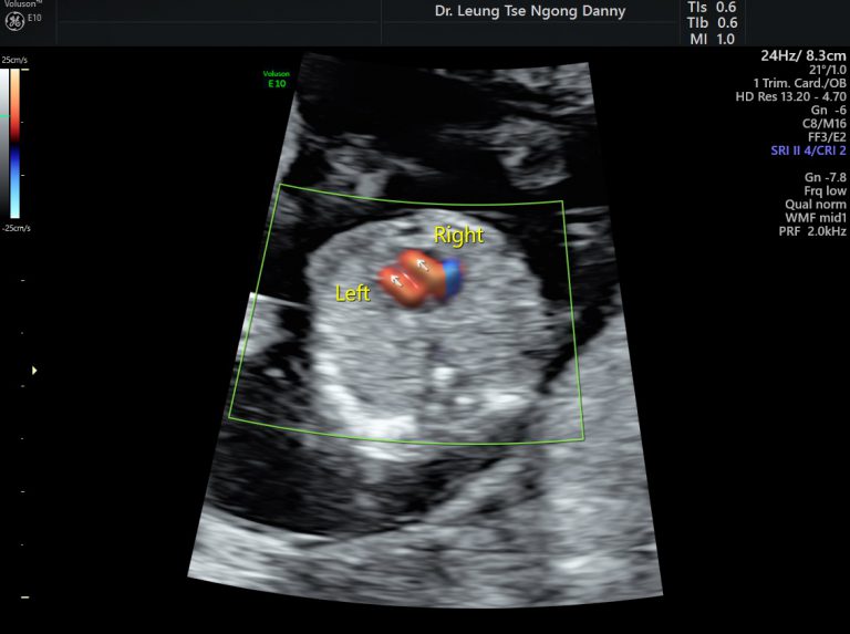 First Trimester Fetal Morphology Scan - HKOG-INFO