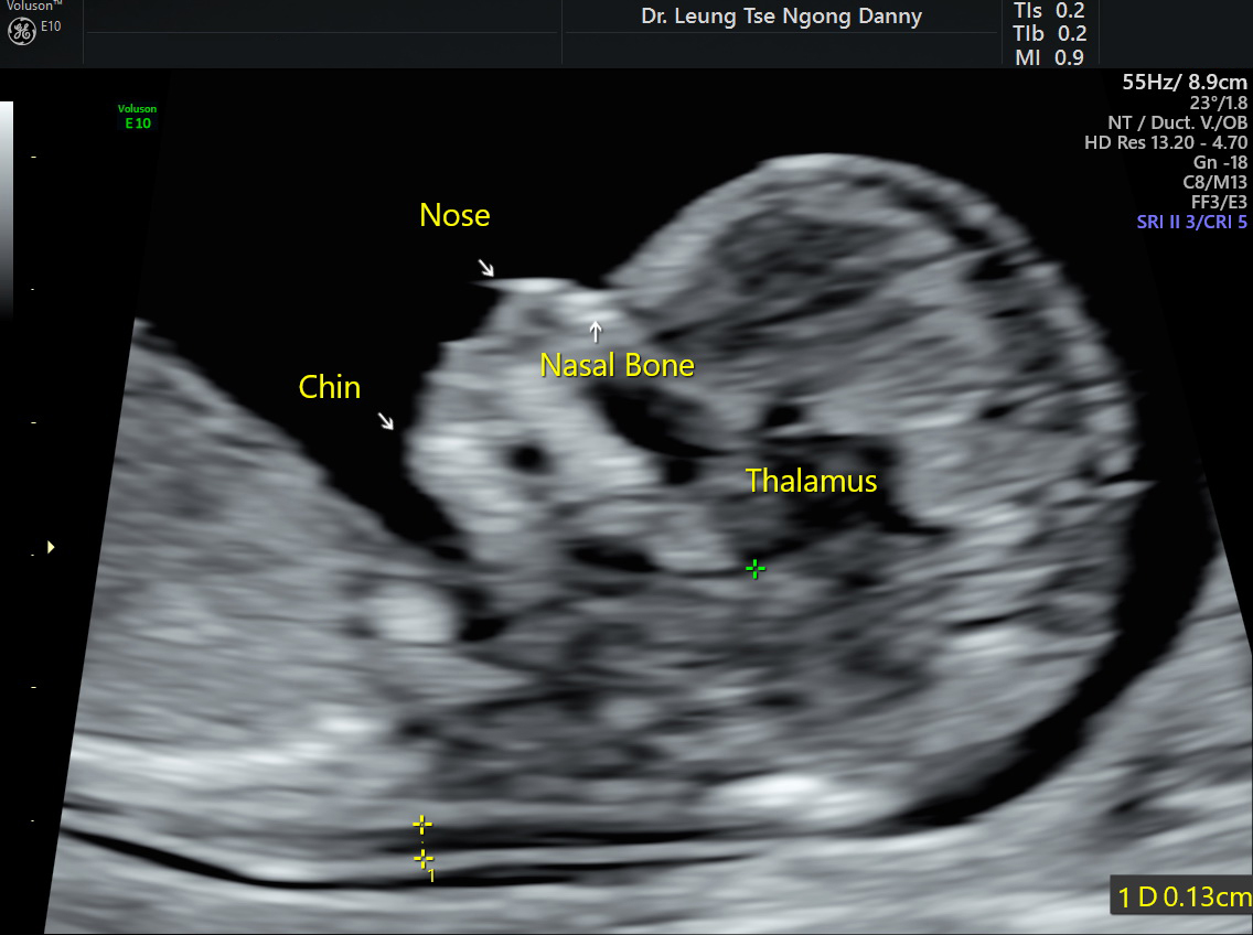 Absence of fetal nasal bone/ hypoplastic nasal bone - HKOG-INFO