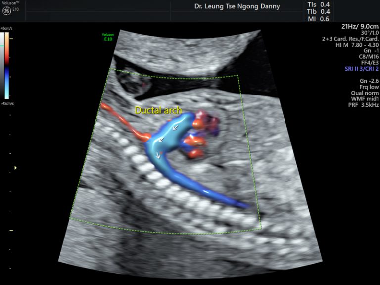 Routine fetal morphology scan - HKOG-INFO