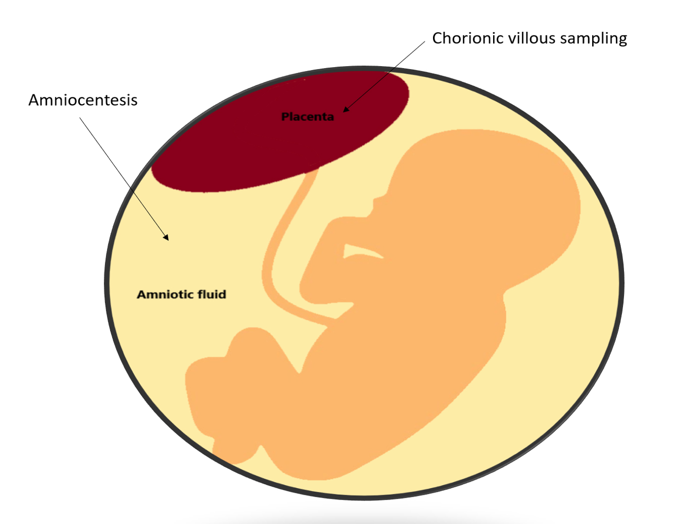 Chorionic Villus Sampling Diagram