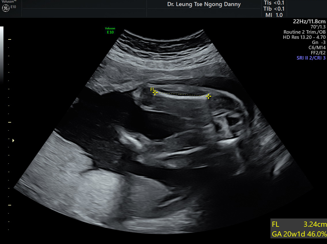 Fetal Biometry HKOG INFO