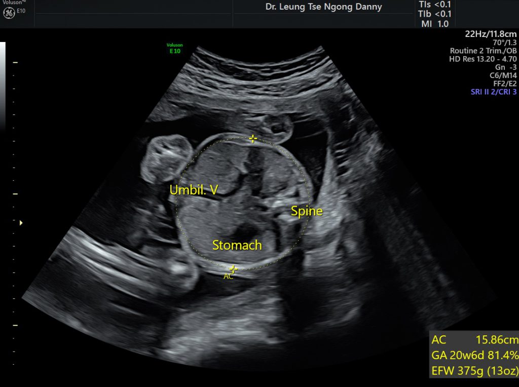 What Causes Large Abdominal Circumference In Fetus