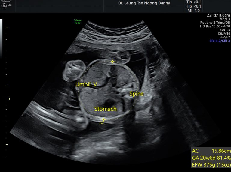 Fetal Biometry HKOG INFO   20w Abdominal Circumference 101282 3 768x573 