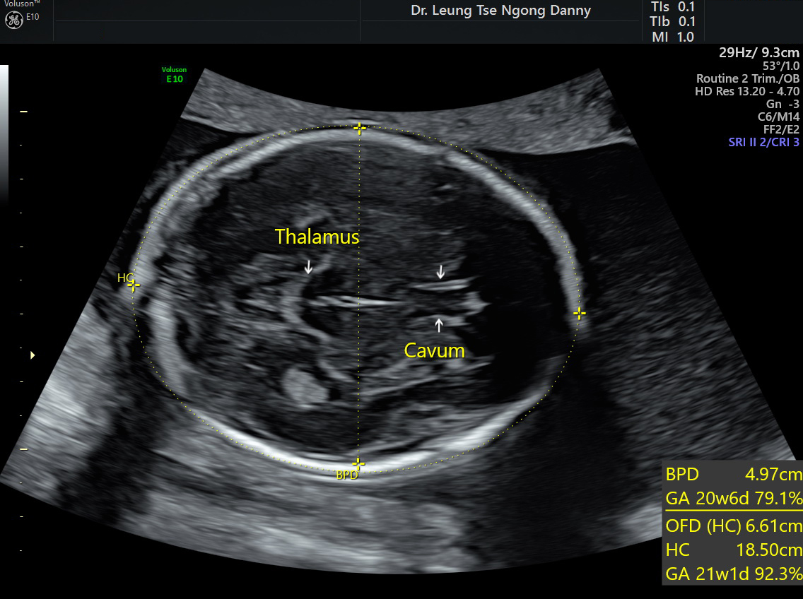 Fetal Biometry HKOG INFO   20w Biparietal Diameterhead Circumference 101282 2 