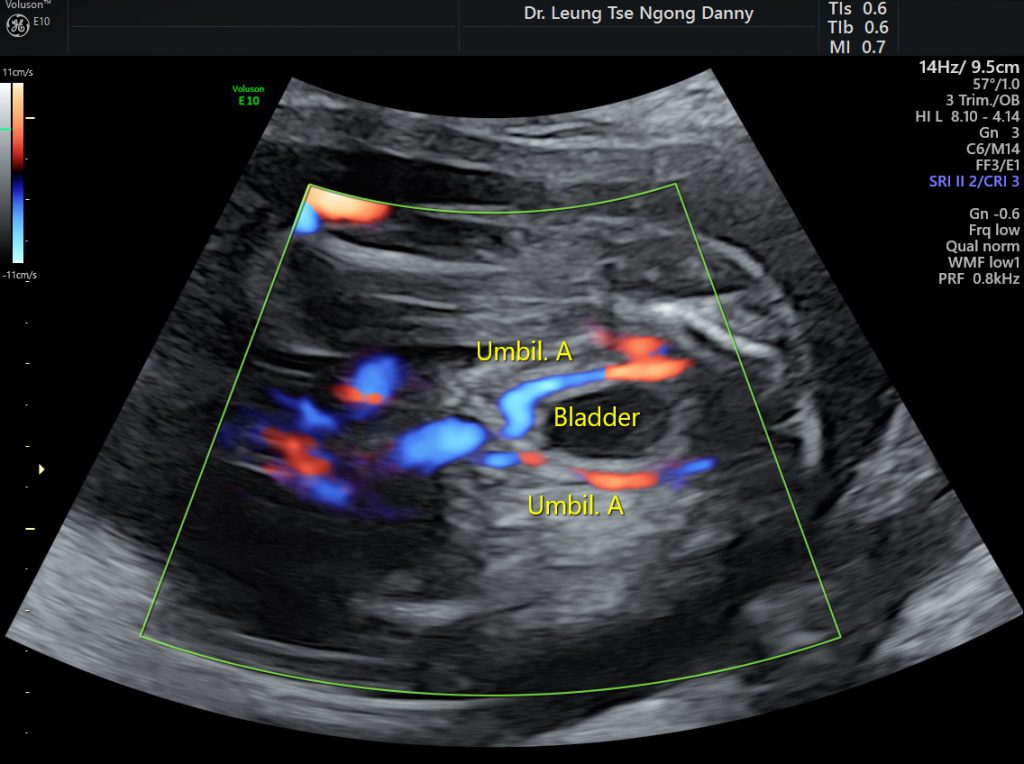 pdf-association-between-isolated-single-umbilical-artery-and