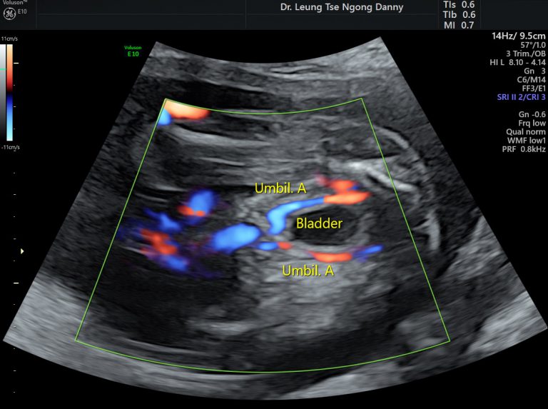 single-umbilical-artery-sua-hkog-info