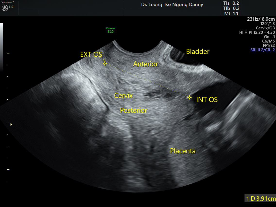 Cervical Incompetence HKOG INFO