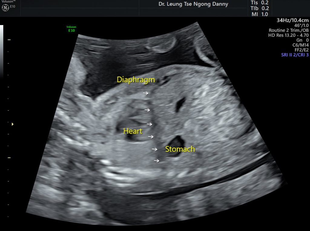 Echogenic Bowel Hkog Info