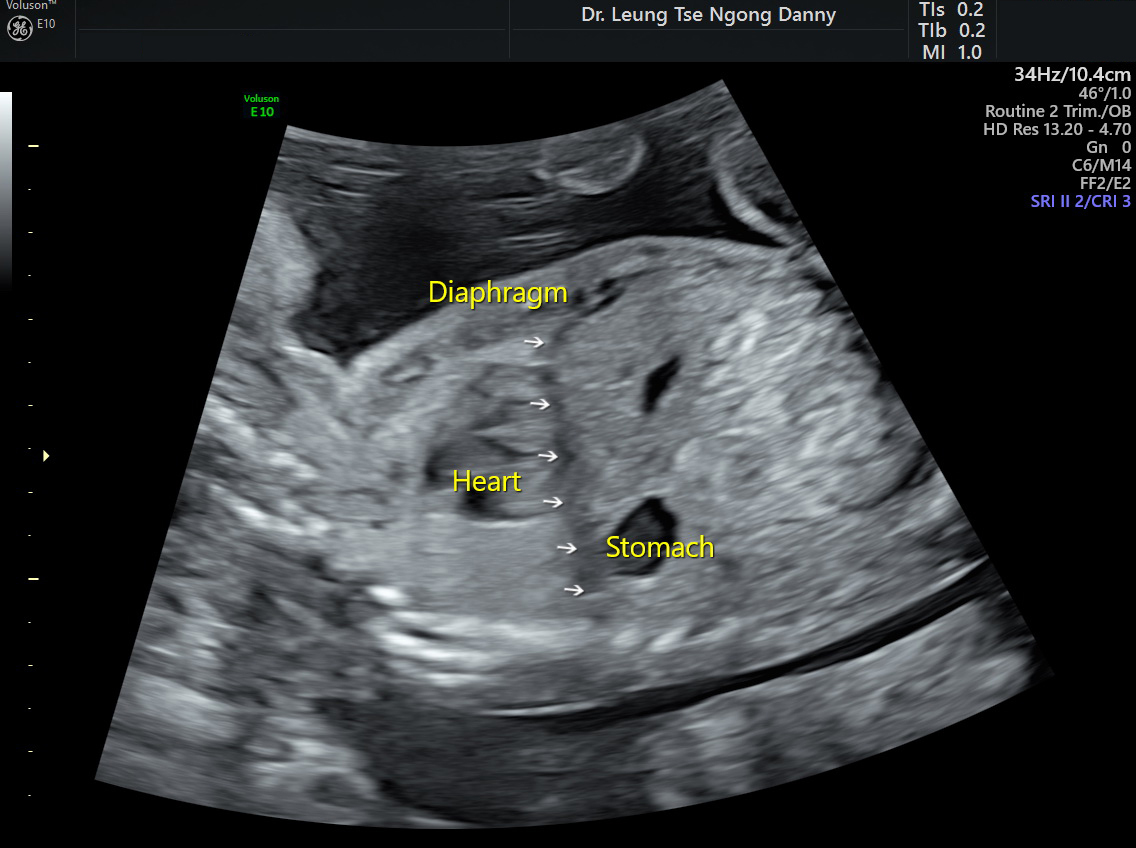 Echogenic Bowel HKOG INFO