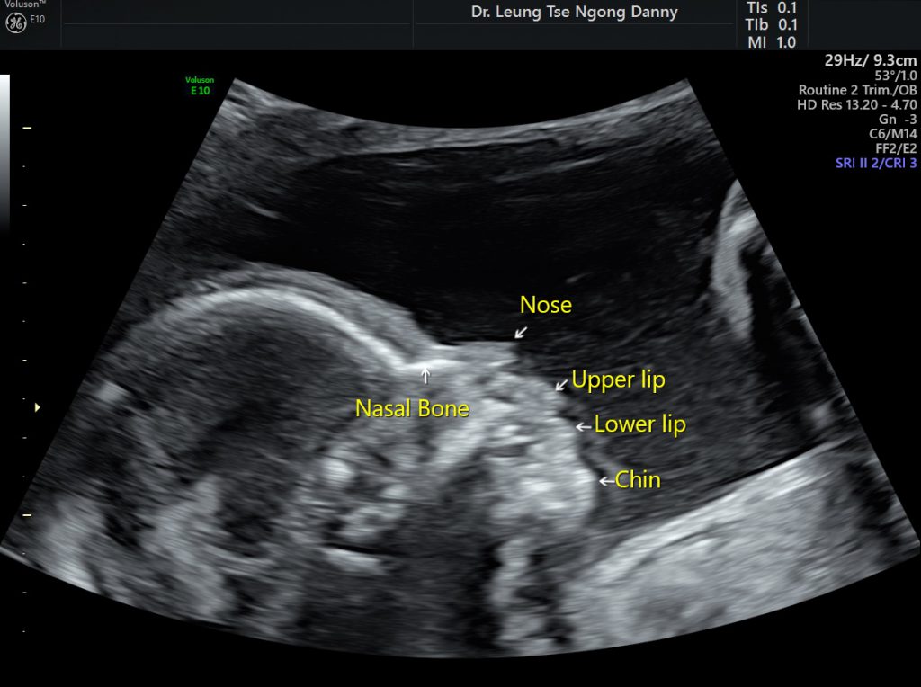 Absence of fetal nasal bone/ hypoplastic nasal bone - HKOG-INFO