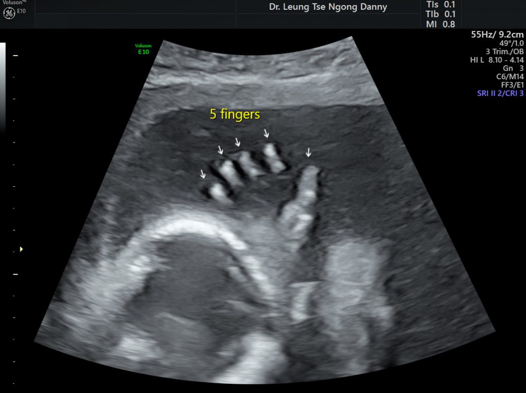Routine fetal morphology scan HKOGINFO