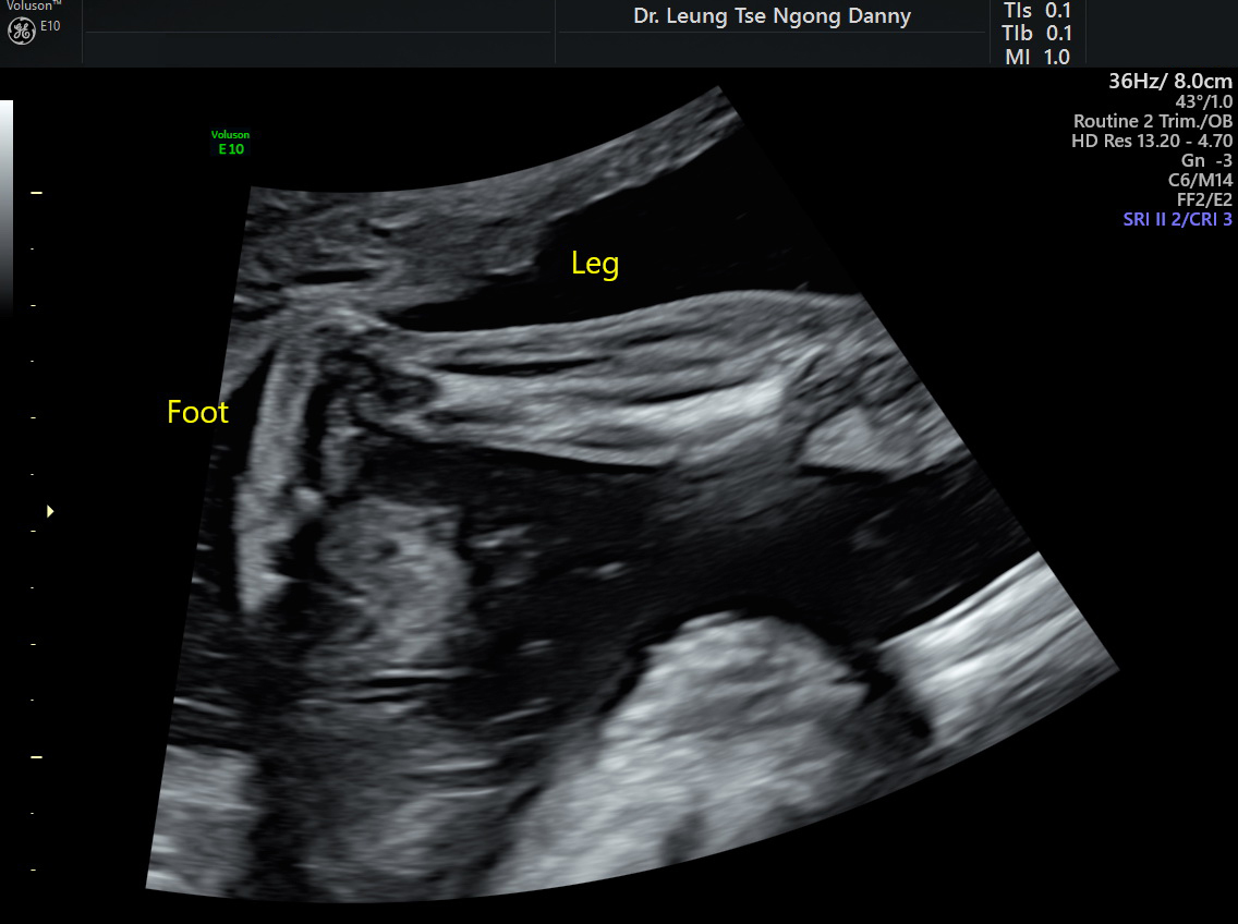 clubfoot deformity measurements x ray