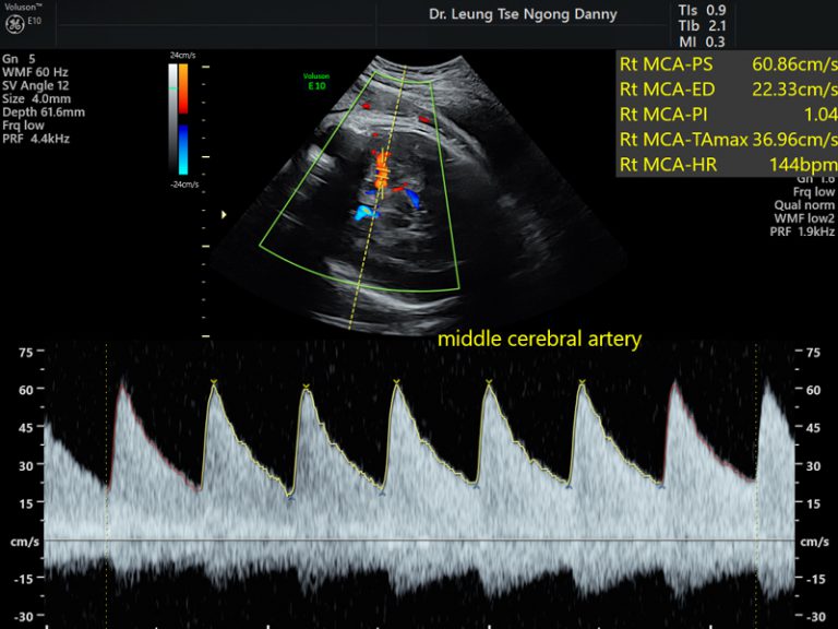 Doppler Ultrasound Hkog Info