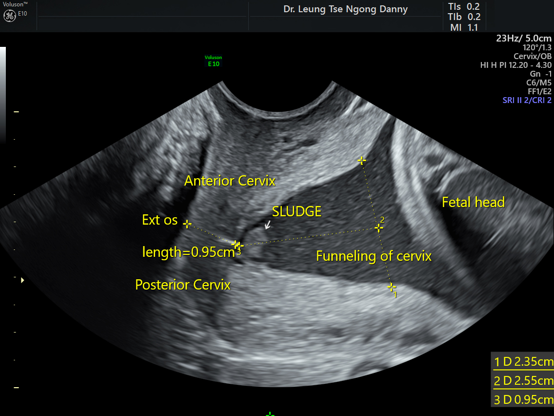 cervical-incompetence-hkog-info