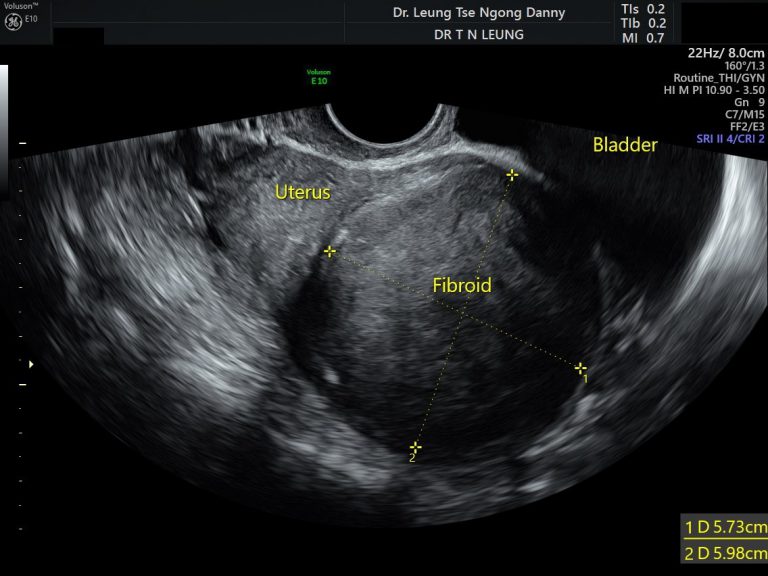 Uterine fibroid (leiomyoma) - HKOG-INFO