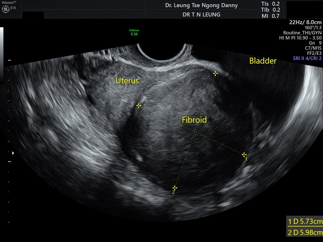 Uterus Fibroid Ultrasound