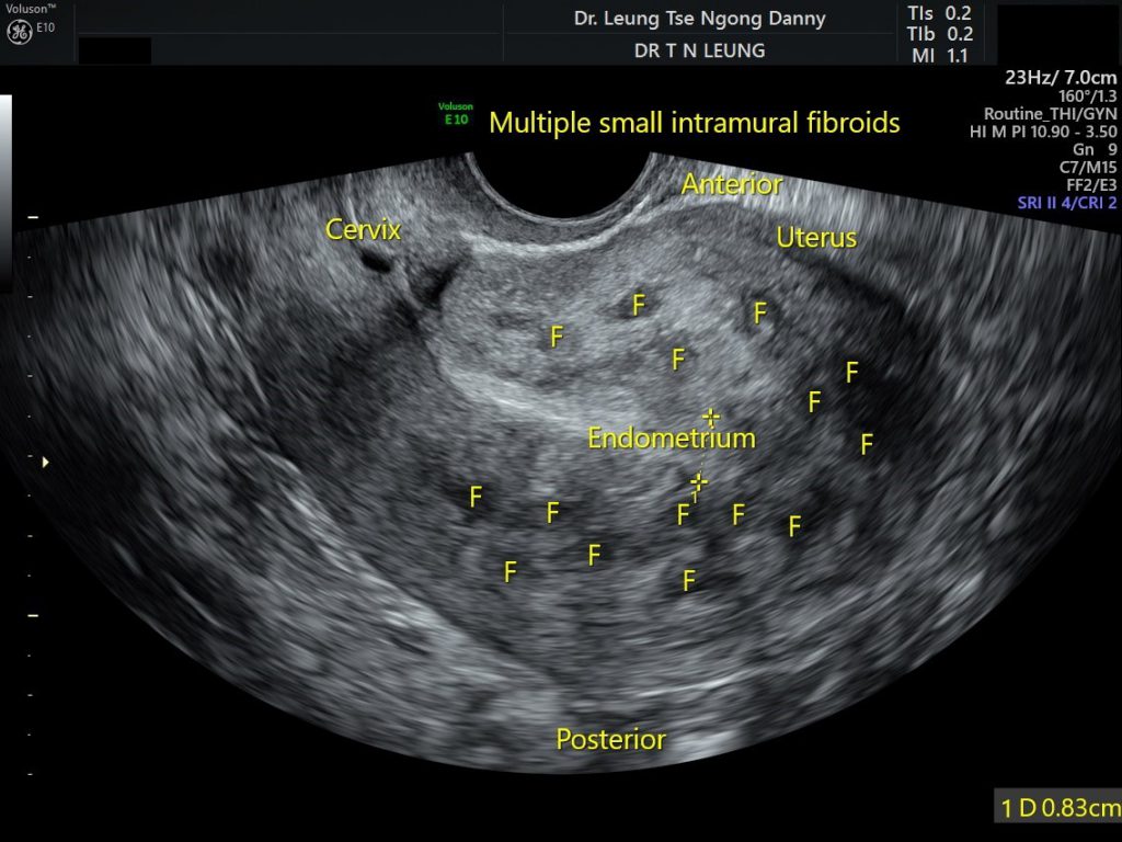 Uterine fibroid (leiomyoma) - HKOG-INFO