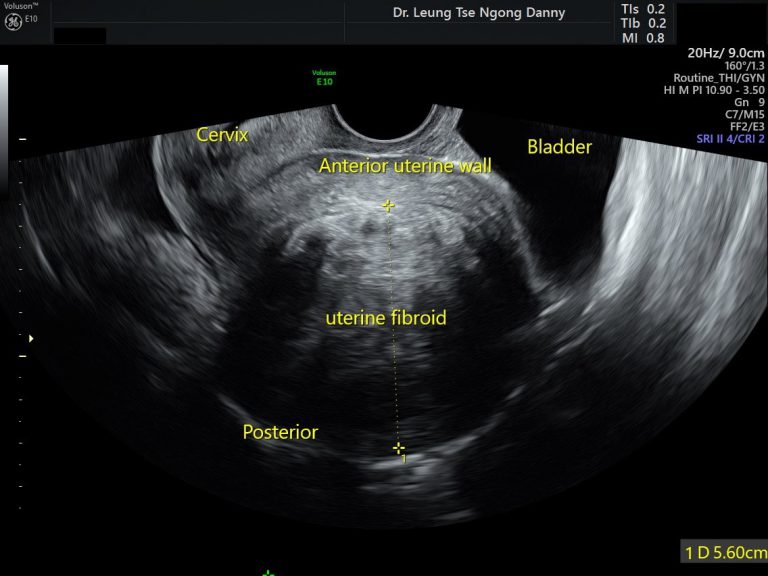 Uterine Fibroid leiomyoma HKOG INFO uterine-fibroid-leiomyoma-hkog-info