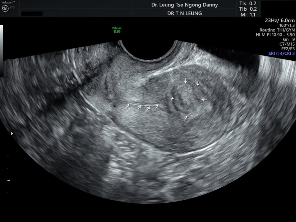 Uterine Fibroid Leiomyoma Hkog Info