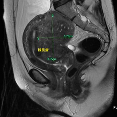 腺肌瘤（磁力共振影像）