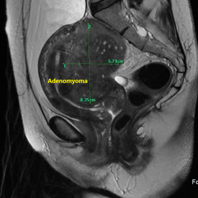 Adenomyoma (MRI)